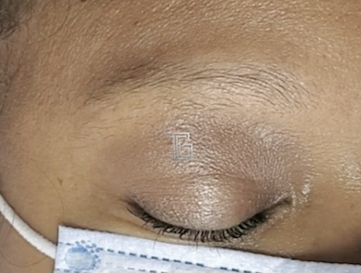 Macro view of natural brow hair distribution before treatment